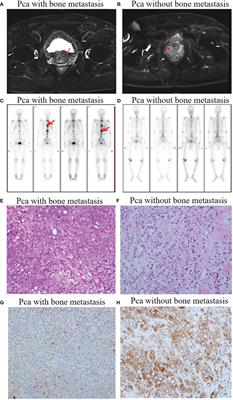 microRNA-145-5p inhibits prostate cancer bone metastatic by modulating the epithelial-mesenchymal transition